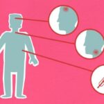 measles symptoms in babies